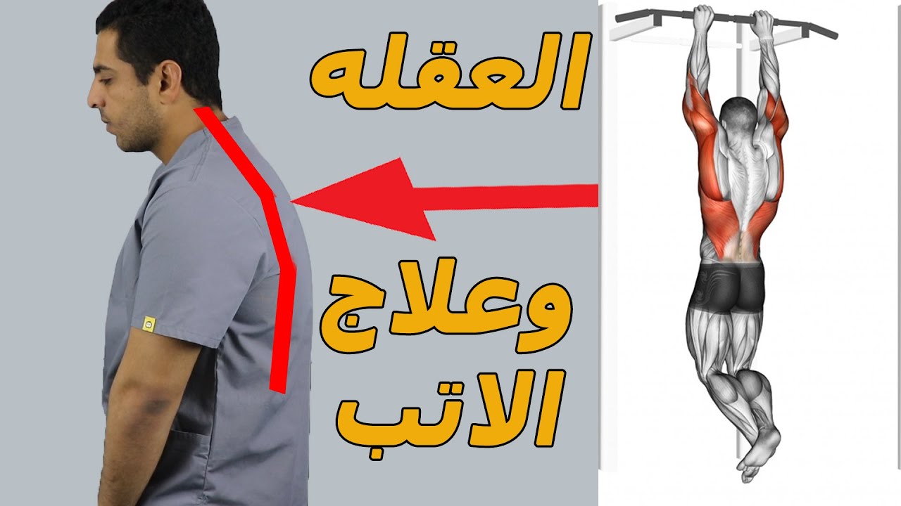 علاج تحدب الظهر(الاتب)بخطوه واحده/العقله هتخلصك من الاتب؟/الجيم بيعالج ...