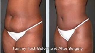 Orlando Tummy Tuck Surgery Before And After Plastic Surgery Orlando Medical Spa