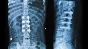 Arthrodesis Anterior technique CPT code - simplify medical coding