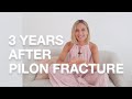 Pilon Fracture Recovery: 3 Years After