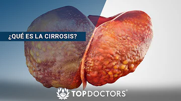 ¿A qué edad es frecuente la cirrosis?