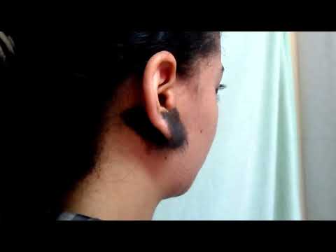 For First Time Aesthetic Removal Of Hairy Congenital Melanocytic Nevi By DR Nader Elmelegy