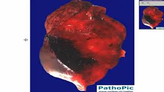 Lung - Acute Infarct - Septic 