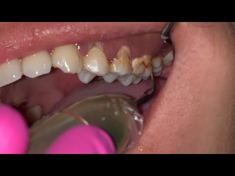 KARANG GIGI PADA GERAHAM ATAS | Dentist | Dokter Gigi Tri Putra 
