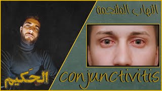  conjunctivitis  احمرار و وجع العين - التهاب الملتحمه