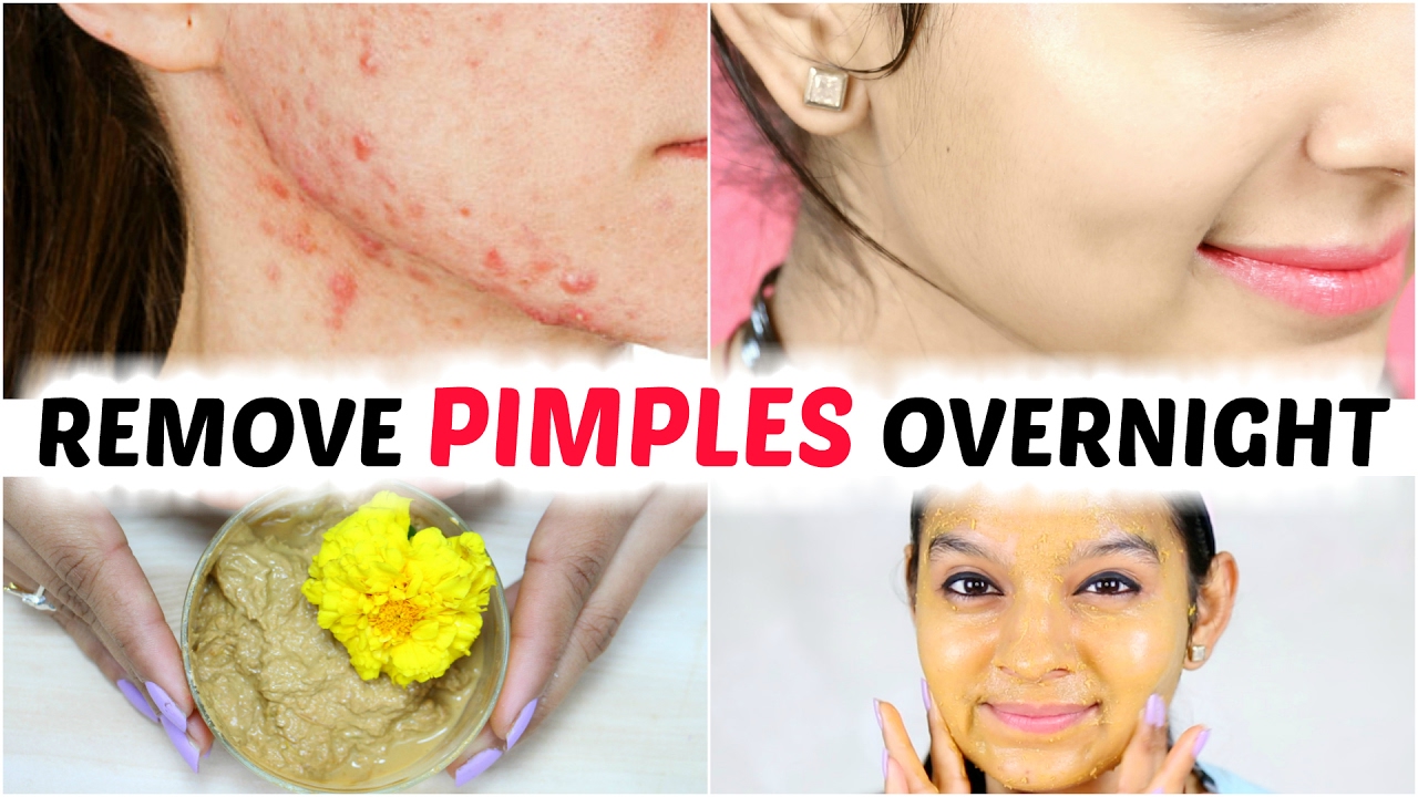 Who to get rid of pimples overnight