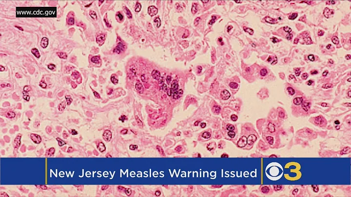 New Jersey Health Officials Warn Of Possible Measles Exposure