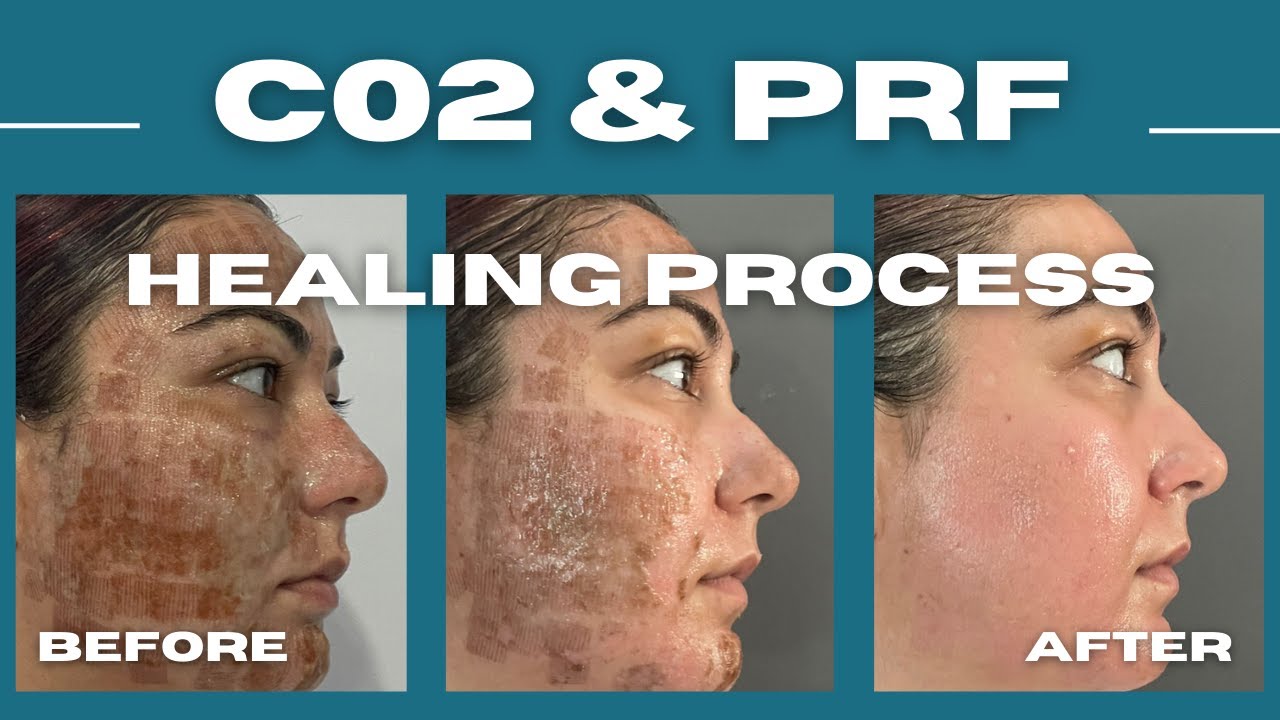 Healing Process of C02 and PRF Treatment