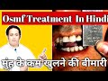 मुंह के कम खुलने की बीमारी । osmf treatment in hindi @DrAmitkrDubey