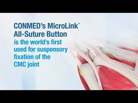 MicroLink™ All-Suture Button - CONMED Product Video