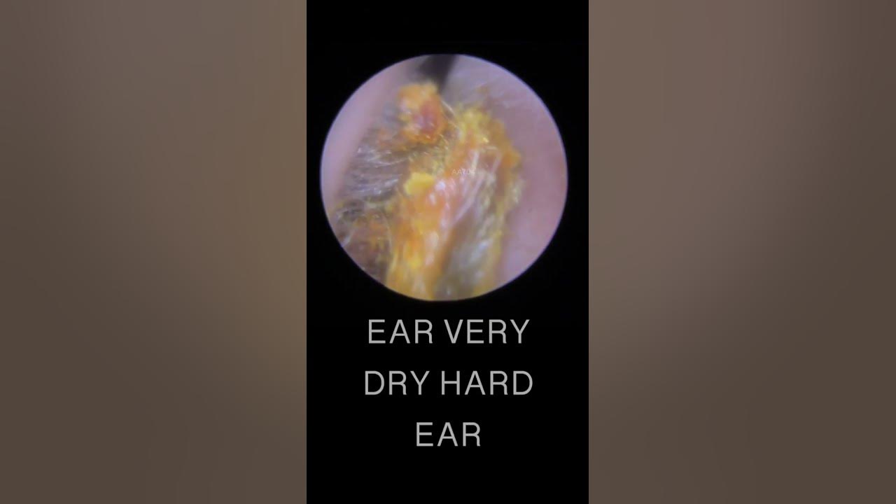 Solid ear wax plug scarred eardrum youtube