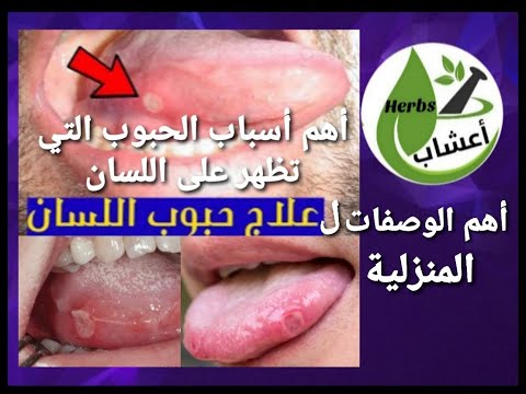 وصفات منزلية لعلاج حبوب اللسان و اهم اسباب ظهورها قناة اعشاب أعشاب حبوب اللسان