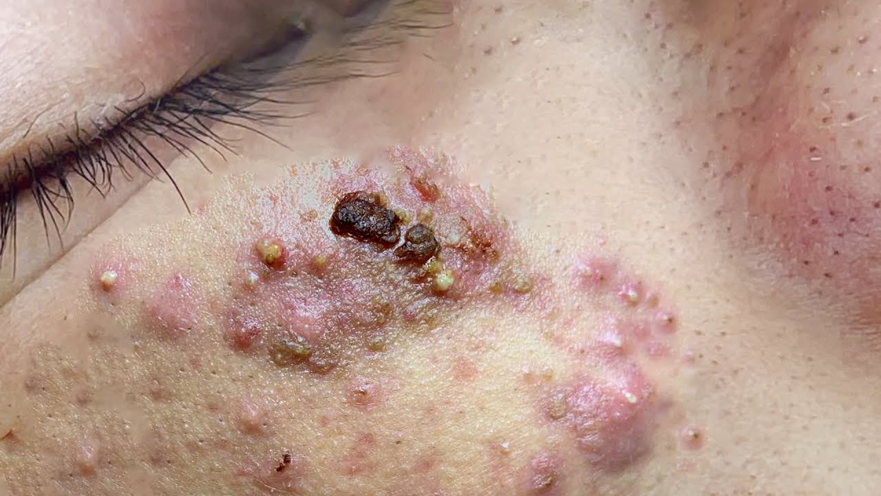 Suri Job #661: Great Inflamed Acne Extraction