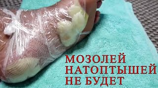 Это невероятно! МОЗОЛИ и НАТОПТЫШИ исчезнут за ВЕЧЕР