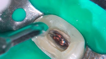 DRendo - Retreatment of a maxillary premolar