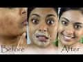 How To Get Rid Of Hyperpigmentation, Dark Upper Lip, Dark Spots & Acne Scars Naturally At Home