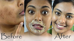 How To Get Rid Of Hyperpigmentation, Dark Upper Lip, Dark Spots & Acne Scars Naturally At Home