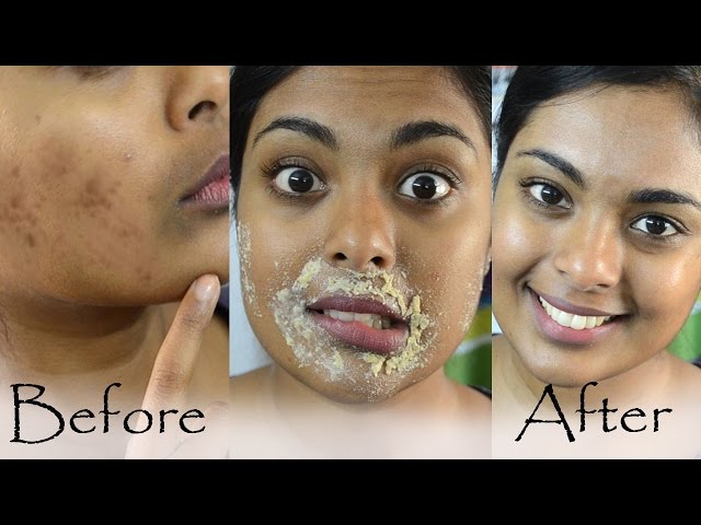 How to get rid of dark spots on black skin