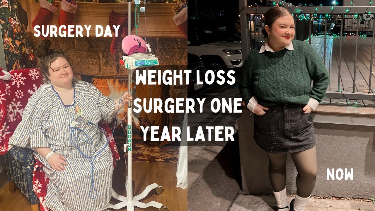one year post gastric sleeve surgery (what they don't tell you!) - YouTube