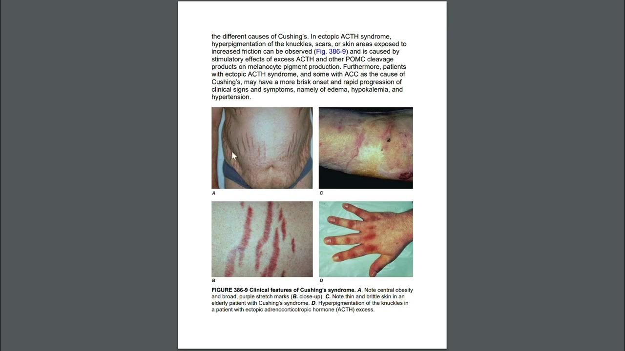 Image based question Clinical signs of Cushing's disease YouTube