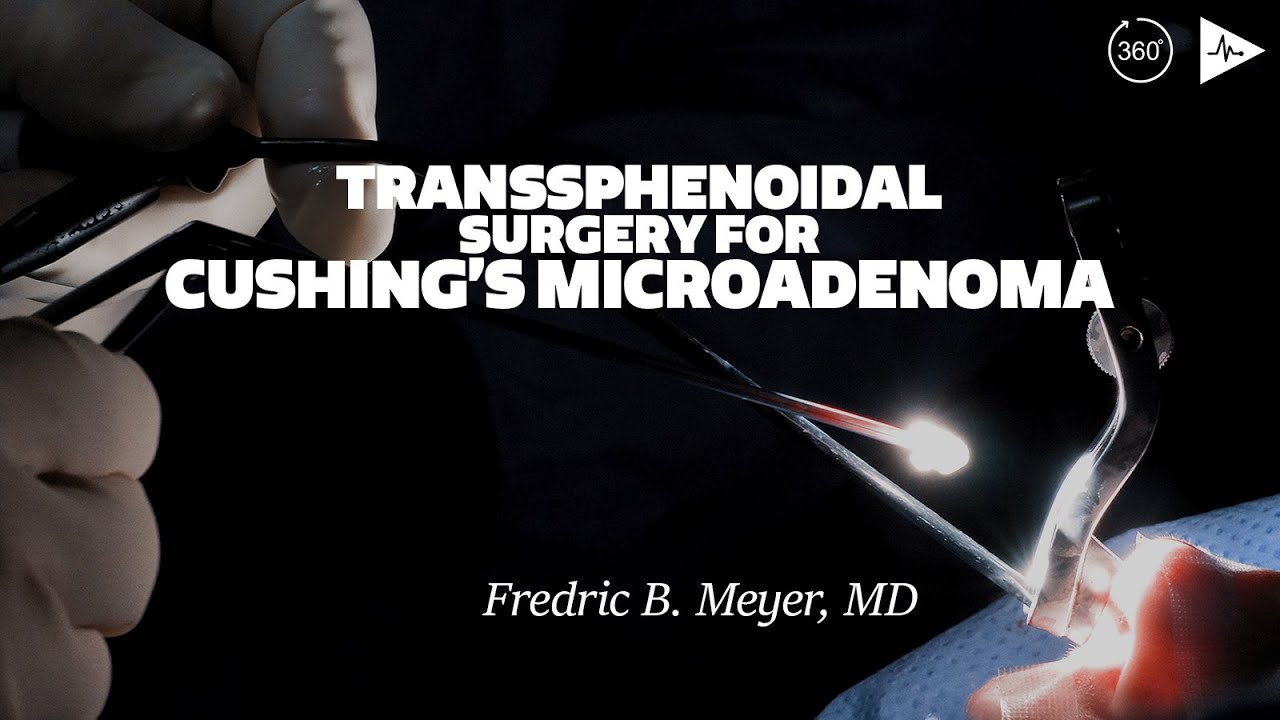 Transsphenoidal Surgery for Cushing's Microadenoma by Fredric B. Meyer, MD physicians formula foundation