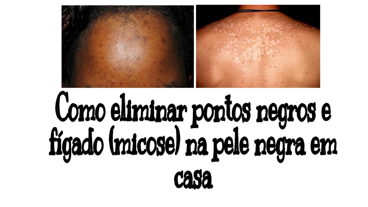 Como eliminar pontos negros e fígado (micose) na pele negra em casa ...