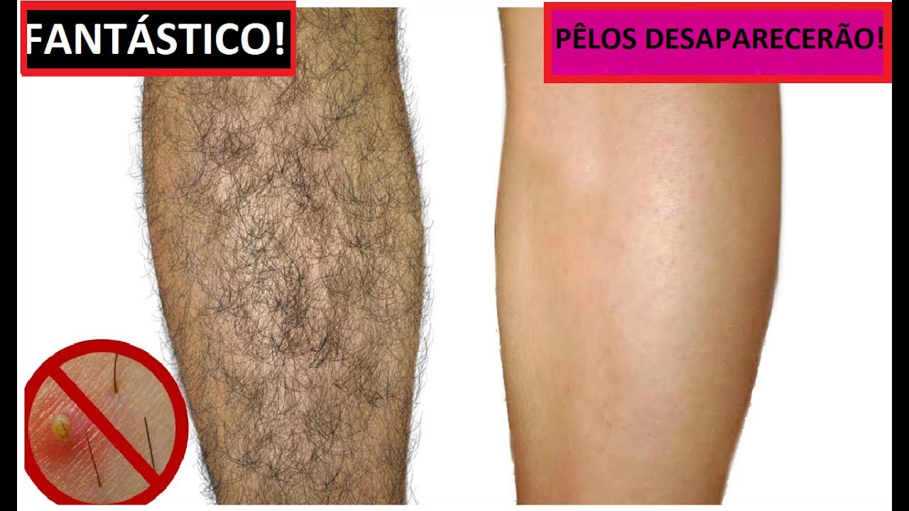 como clarear connective tissue pelos das pernas naturalmente