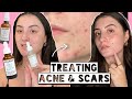 SKINCARE INGREDIENTS FOR TREATING ACNE &amp; ACNE SCARS | Hollaface Skincare Routine Review