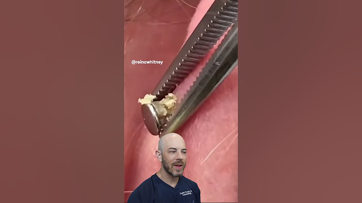 Uh Oh!😦 This infected ear piercing isn’t being treated properly!(credit: @reinawhitney on TT)#react