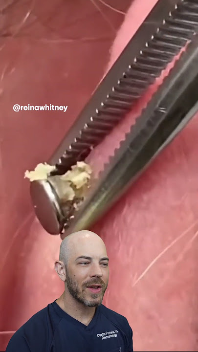 Uh Oh!😦 This infected ear piercing isn’t being treated properly!(credit: @reinawhitney on TT)#react