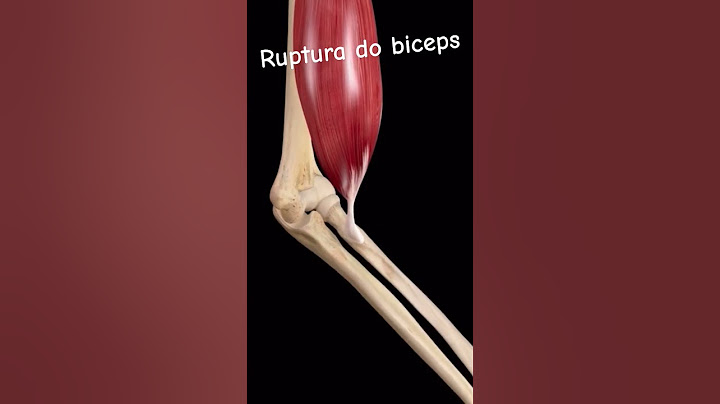 #ortopediaetraumatologia #ortopedista #biceps  Ruptura do biceps e suas perdas!
