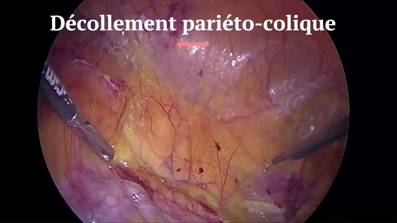 Néphrectomie gauche laparoscopique décollement colique, Full Length Procedure YouTube