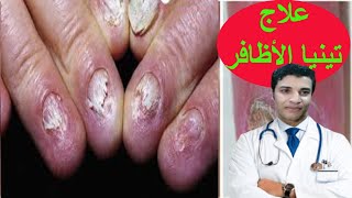 اسباب وعلاج فطريات الاظافر والقدم بطريقه صحيحه وفعاله  طبقا لاخر ابحاث علميه_onychomycosis