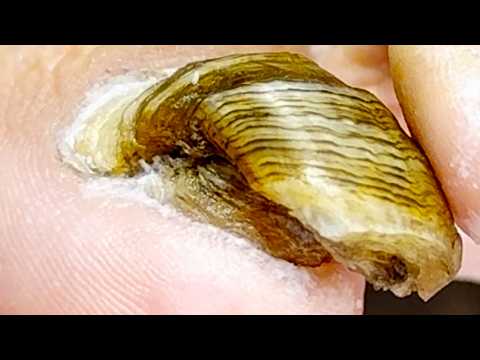 Onychomycosis Trimming, Super Protrusions!【Xue Yidao】