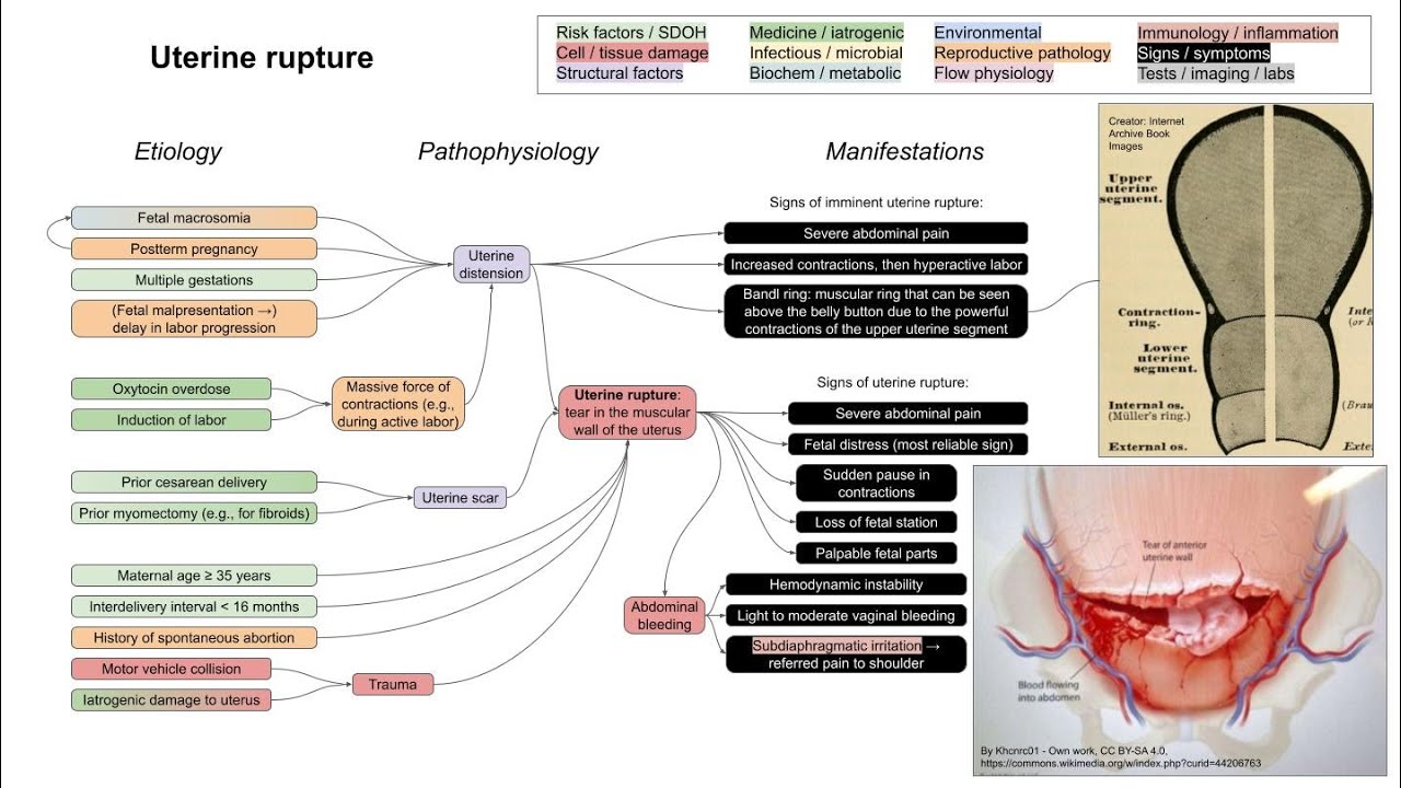 Uterine Rupture mechanism Of Disease YouTube Uterine Rupture mechanism Of Disease YouTube
