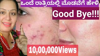 #kannadavlogs#modave#marks#pimple#removal#natural#howto#acne#homeremedy#kannadavlogger#kannadavlogs#kannadarecipes#kannadavlogschannel#kannadabeautychannel#k...