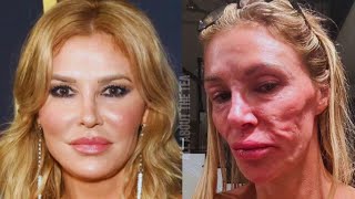 Brandi Glanville Faces Darkest Days: The Shocking Impact of Her Facial Disfigurement on Her Life