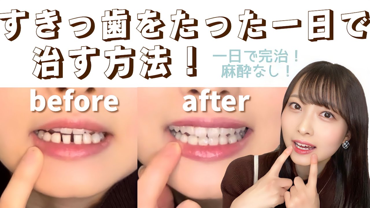 【一日で完治！】すきっ歯をたった一日で治してきた🦷