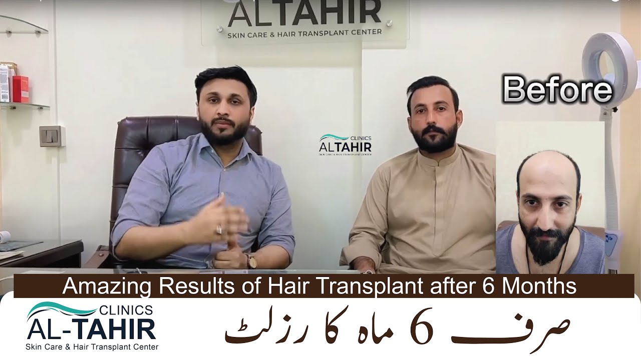 Amazing Results Of Hair Transplant After 6 months at Al Tahir skin care