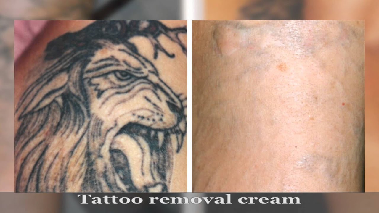 Wrecking Balm Tattoo Remover Benefits Of Laser Tattoo.