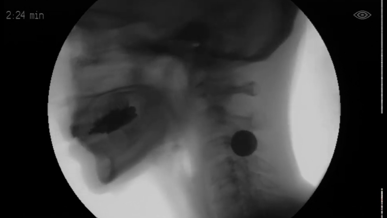 Barium Pill Embedded in Assure SlideZero (Phazix) YouTube