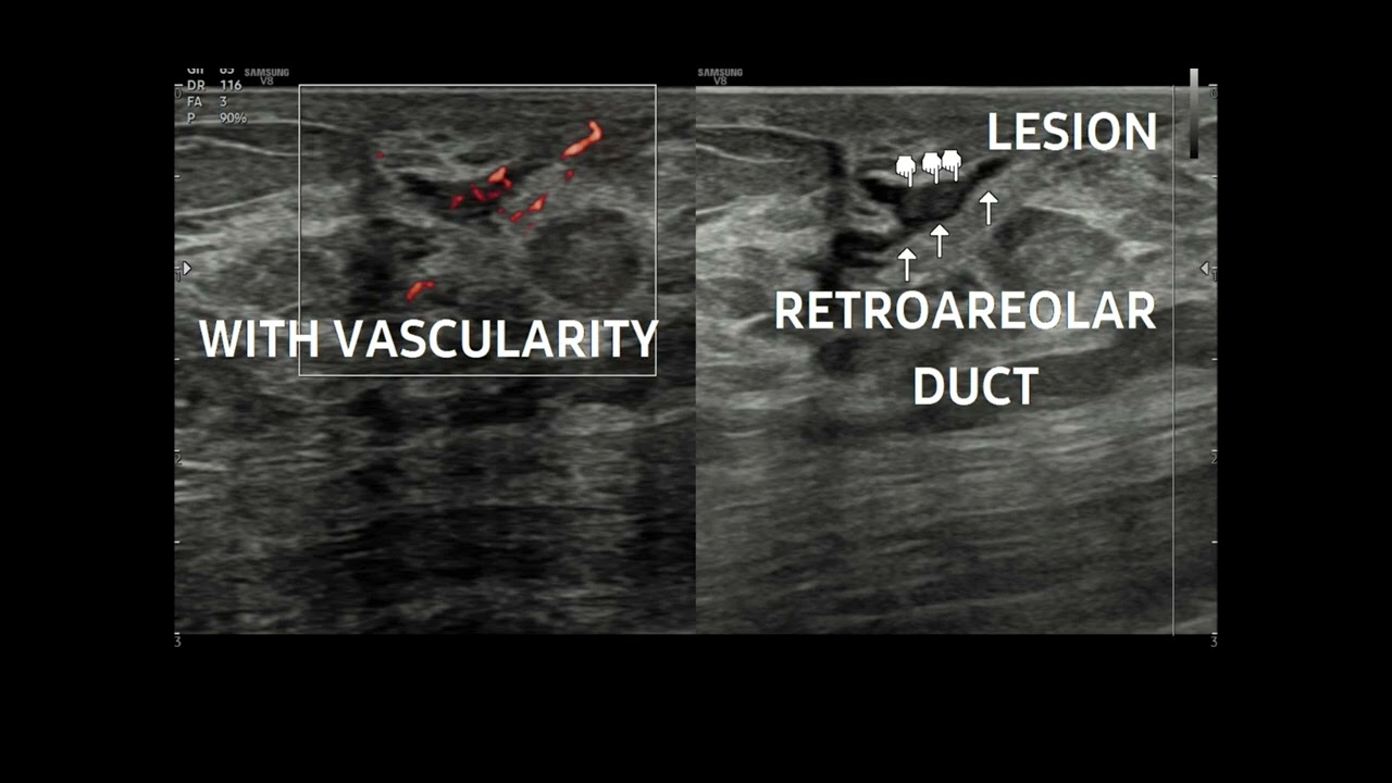 Breast Ultrasound Solitary Intraductal Papilloma In Right Breast Breast Ultrasound Solitary Intraductal Papilloma In Right Breast