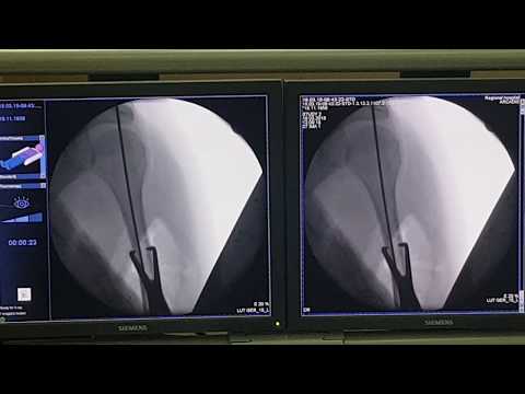 Видео: ORIF хирургия: отворена редукция вътрешна фиксация за счупени кости