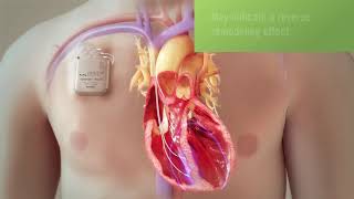 Cardiac Contractility Modulation Information For Providers