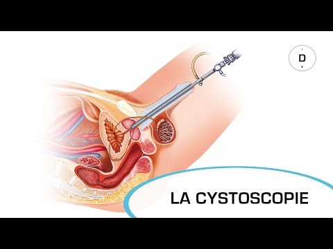 Vidéo: Cystoscopie - Contre-indications, Conséquences