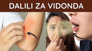 Dalili za vidonda vya TUMBO na UTUMBO