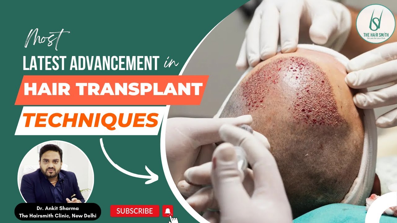 Most LATEST ADVANCEMENT in Hair Transplant Techniques - YouTube