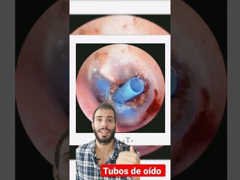 Video: ¿Cuándo usar la membrana de ventilación?