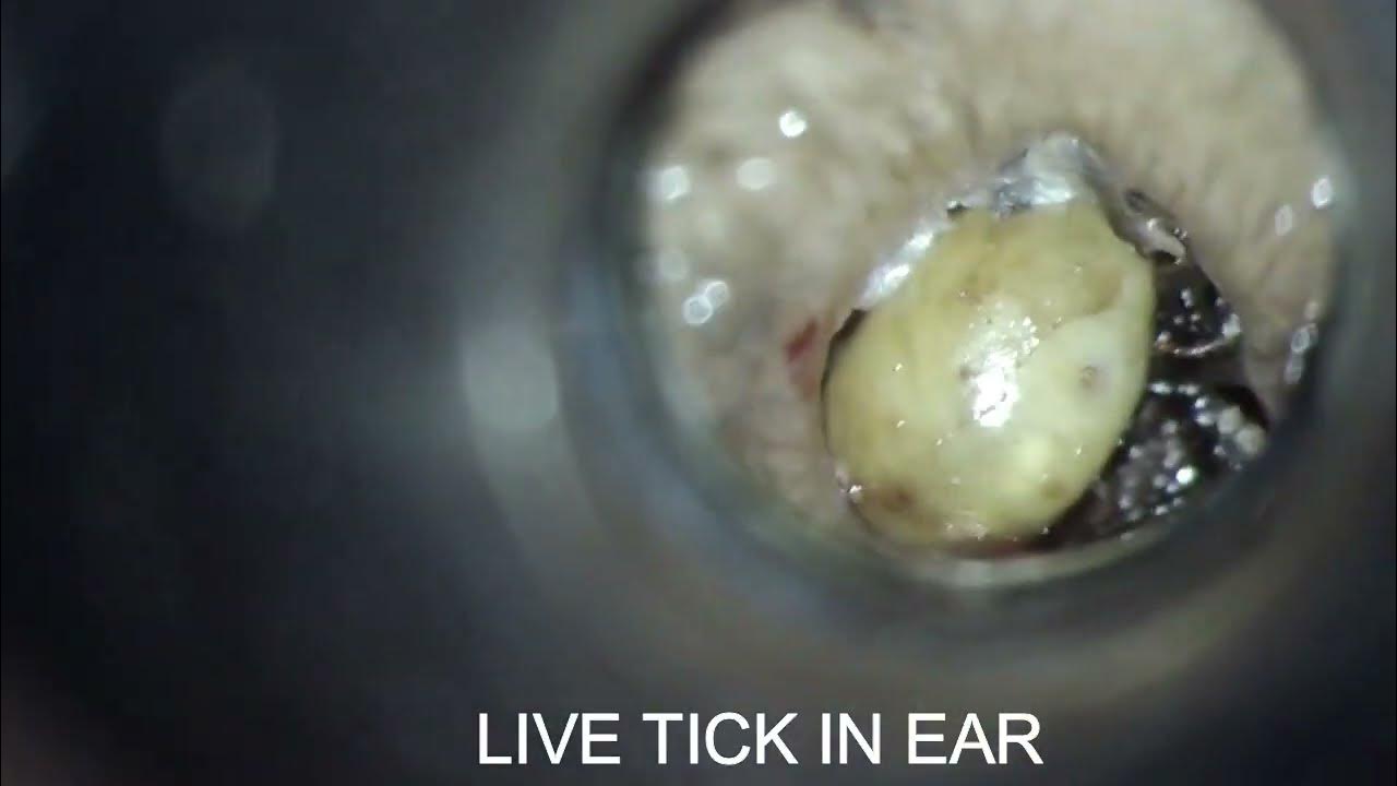 LIVE TICK IN EAR????????????REMOVED DR. SHREE HARSHA THULAPULE. YouTube