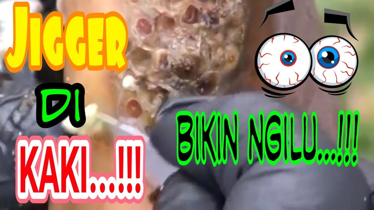 JIGGER/ larva lalat yg bersarang di kaki YouTube
